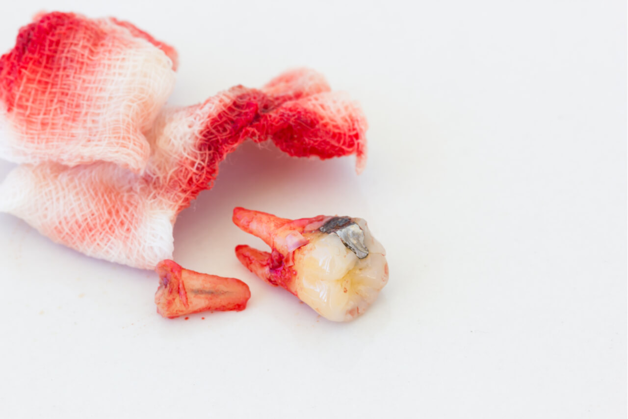 pressing a piece of gauze on the gum is the first step of how to stop bleeding after tooth extraction