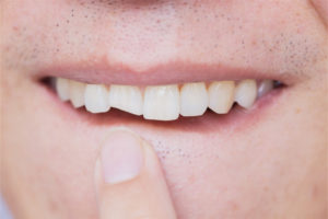 What to do if you hit your tooth and it is broken