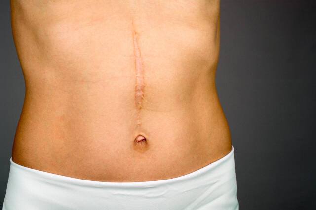 Scar Tissue Removal Surgery