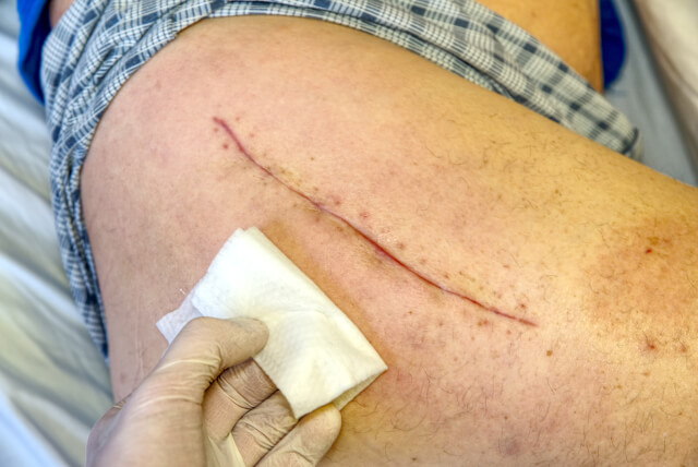Open Wound Care After Surgery