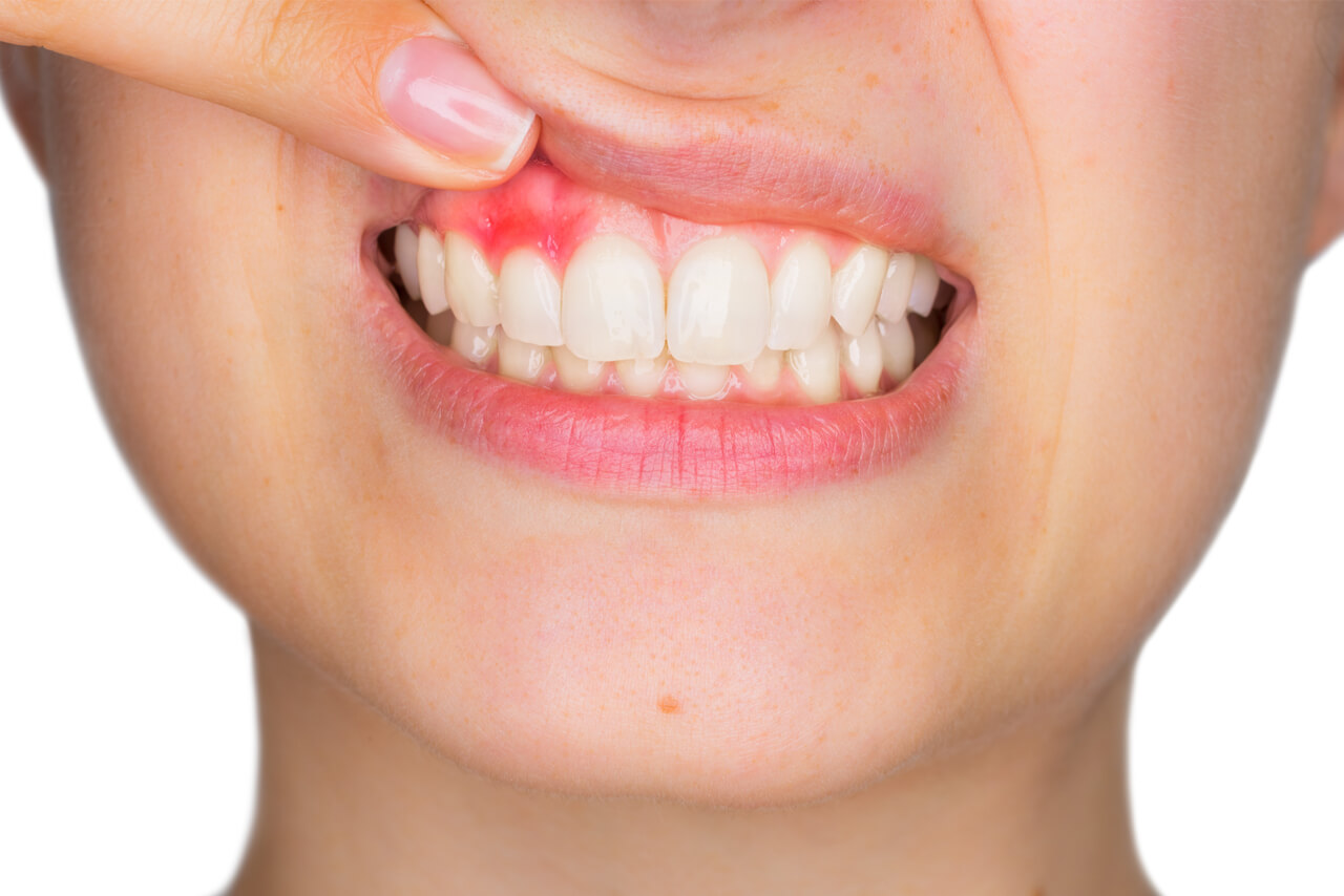 how to reduce swelling in gums